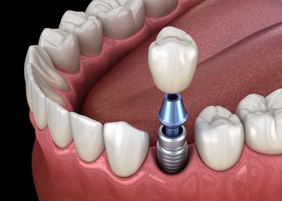 dental implants, missing teeth, oral health, implant benefits, Southwest Smiles, Austin TX, Dr. Lakshmi Chittajallu