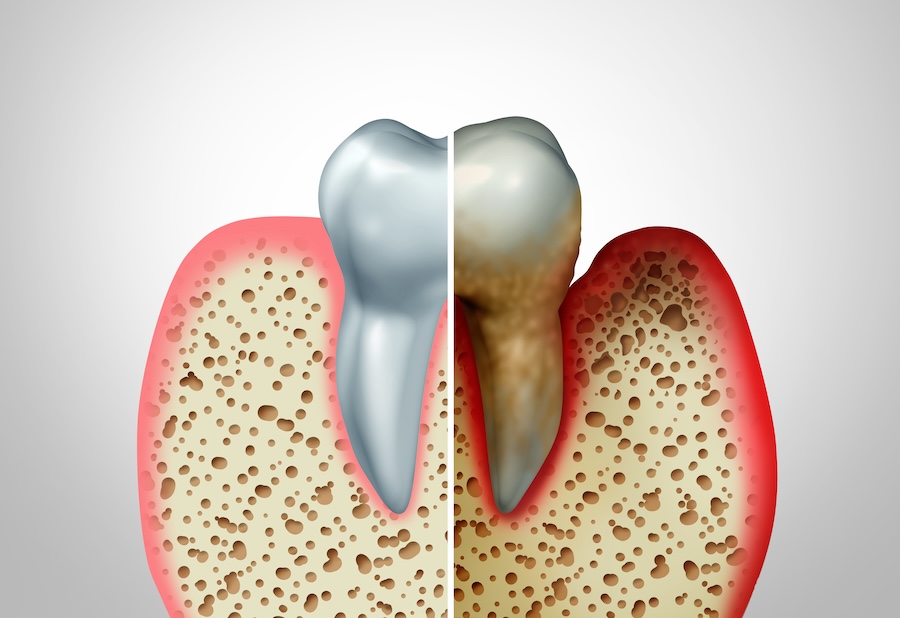 gum disease, stages of gum disease, periodontitis, gingivitis, dentist in Austin, TX, oral health, gum health, periodontal disease